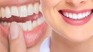 Porcelain veneers smile makeover in Lucknow