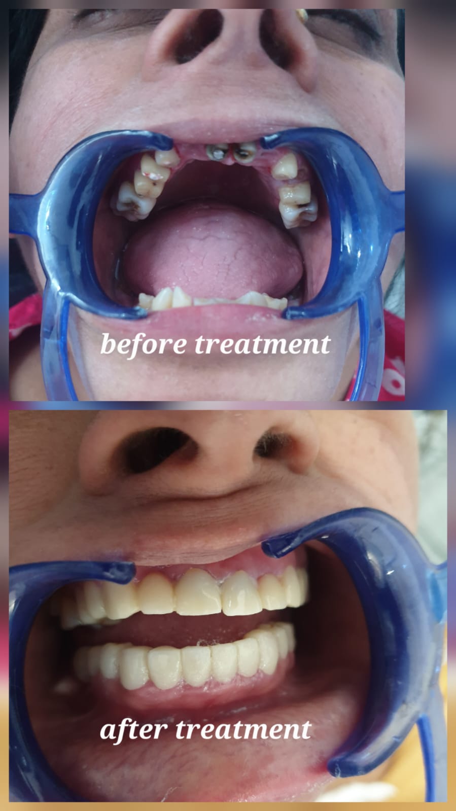 Gum disease treatment illustration