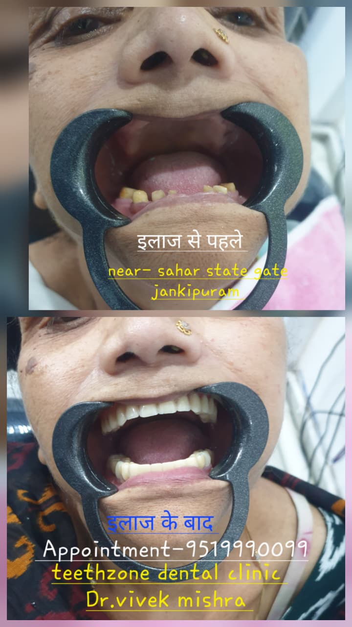 Professional dental cleaning at TeethZone